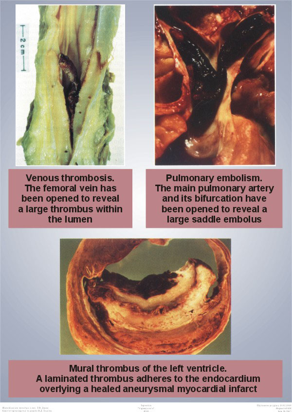 Venous Thrombosis Pulmonary Embolism Mural Thrombus Of The Left Ventricle Venous Thrombosis Pulmonary Embolism Mural Thrombus Of The Left Ventricle